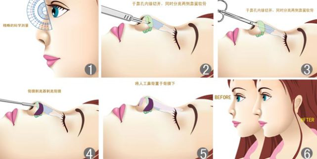 最新鼻部護理技巧，塑造完美鼻型的秘訣