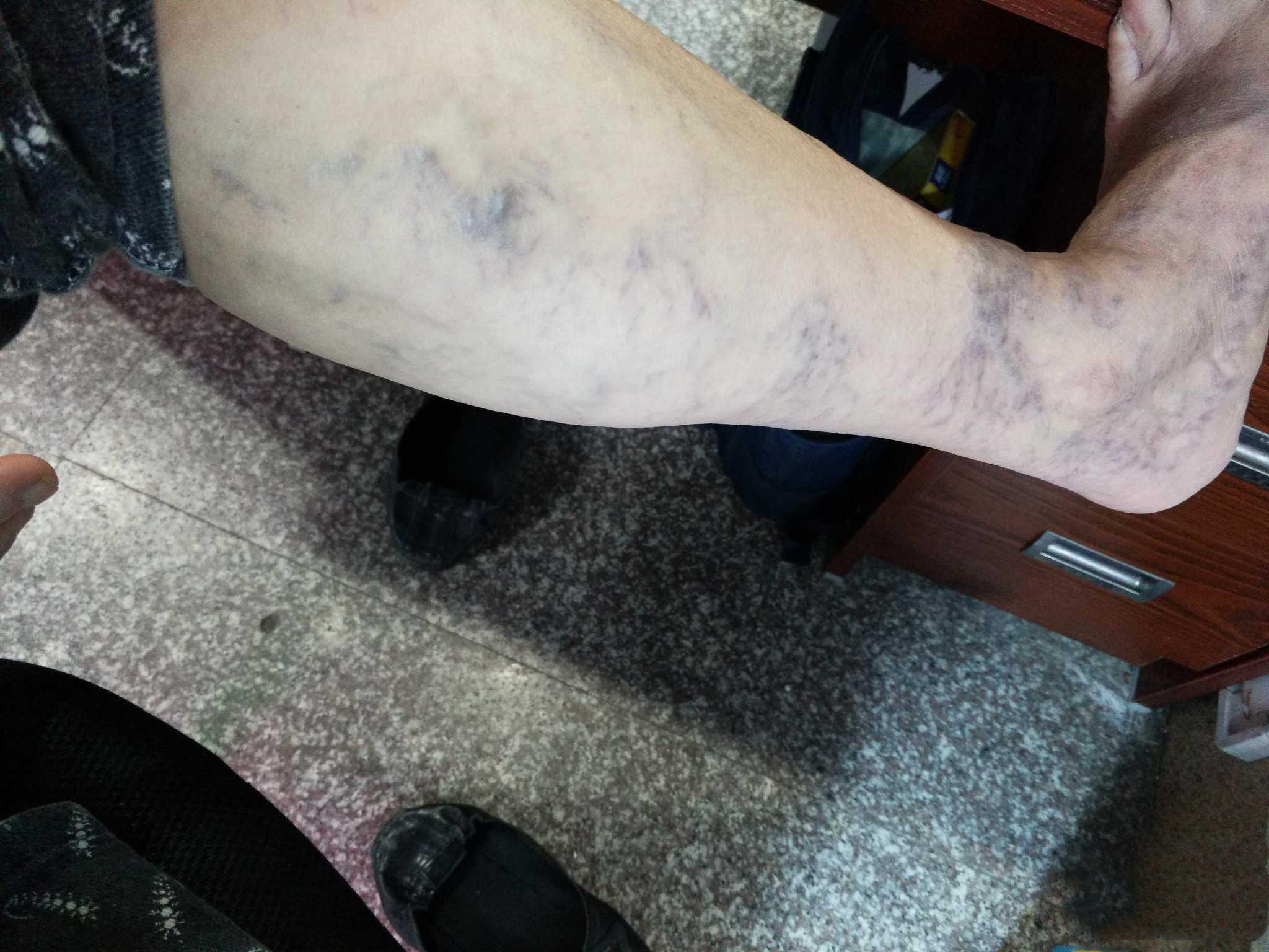 靜脈曲張新療法觀點(diǎn)論述與解析