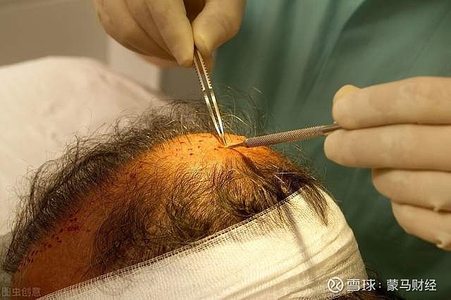 國際前沿脫發(fā)治療技術(shù)及其觀點(diǎn)論述