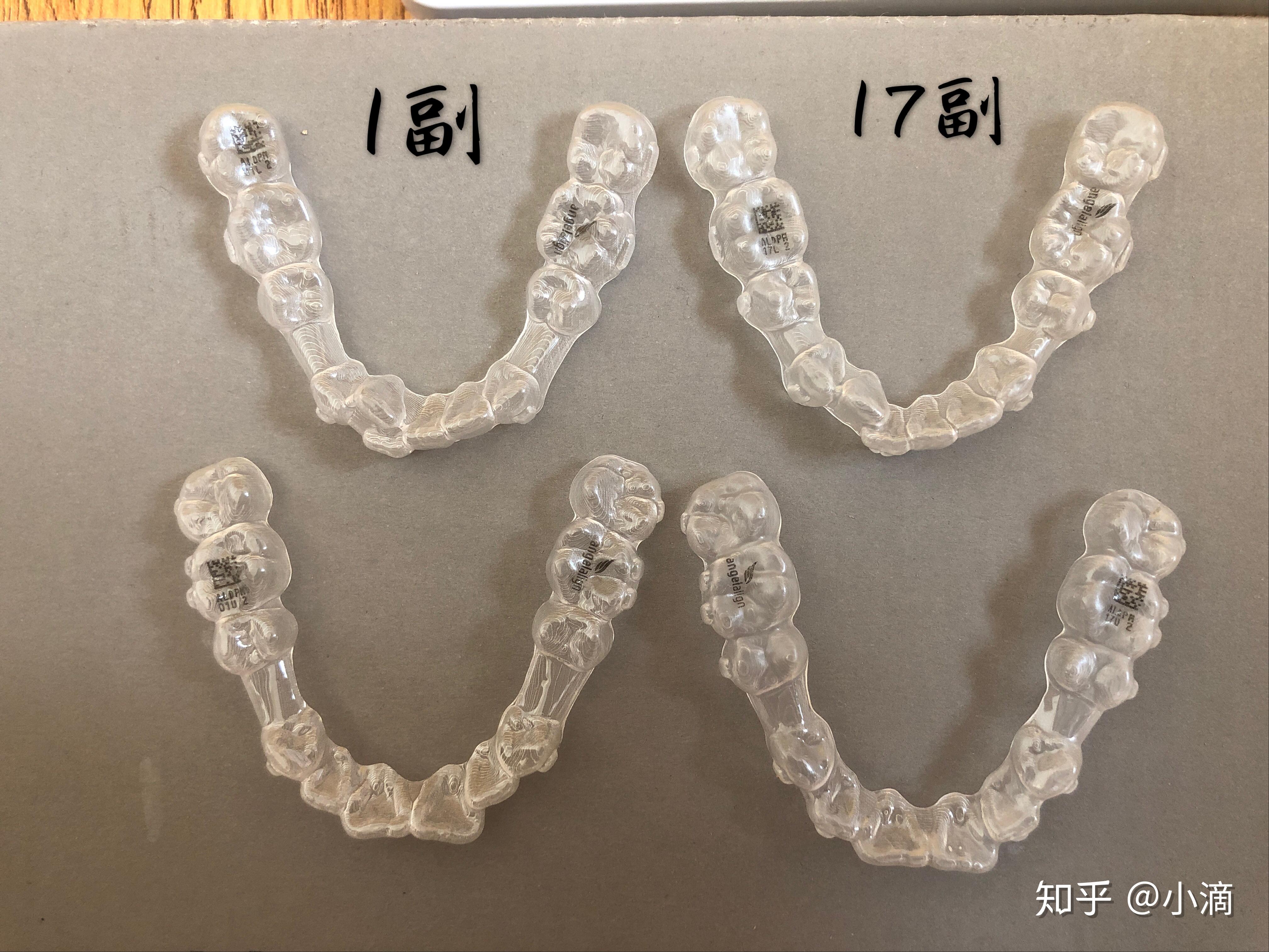 時代天使牙套價格揭秘，小巷中的美麗蛻變之旅啟動！