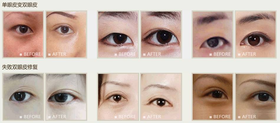 眼部整形新技術(shù)介紹與探討