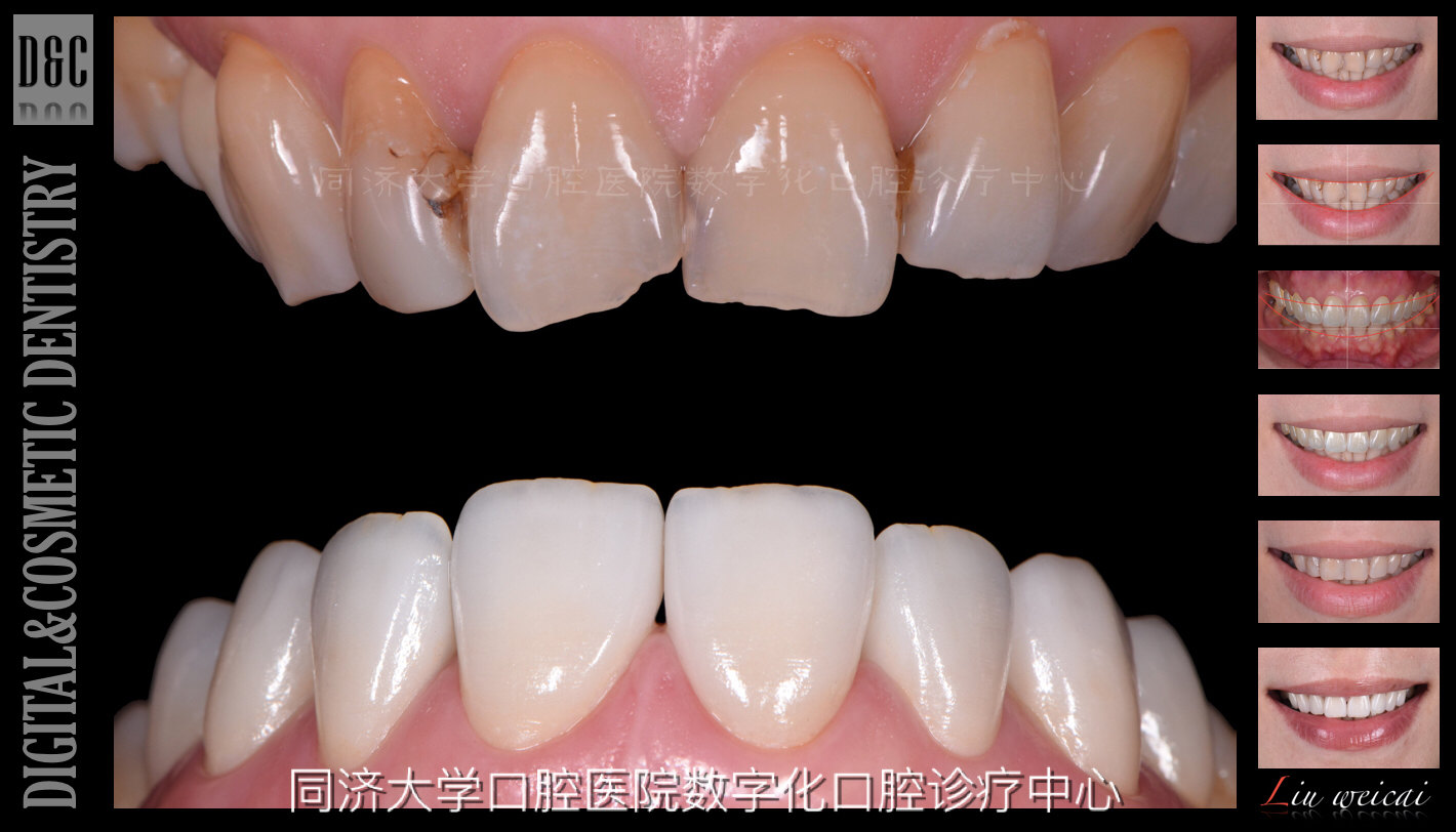 四環(huán)素牙貼面價格解析與比較指南