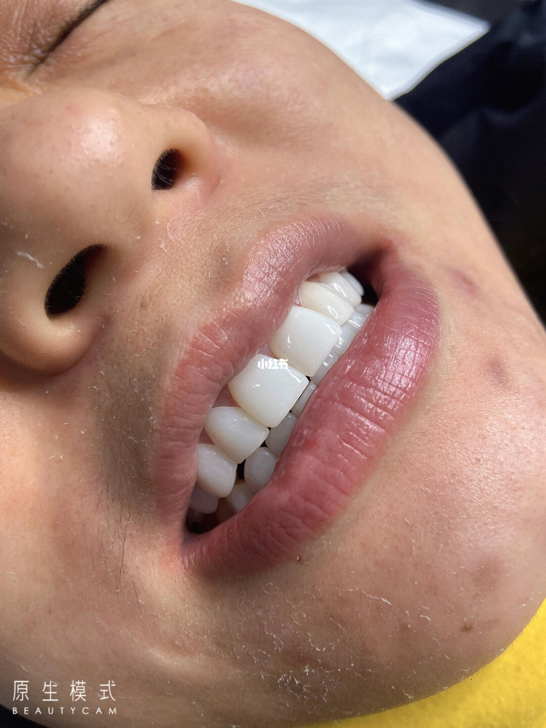 四環(huán)素牙貼面價(jià)格解析與比較指南