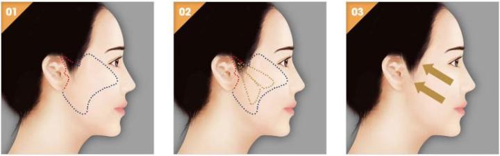 面部提升最新方法與小巷深處的秘密小店揭秘