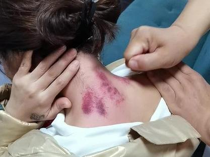 最新擰痧步驟指南與操作詳解